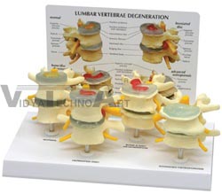 Four Stage Lumbar Vertebrae Set